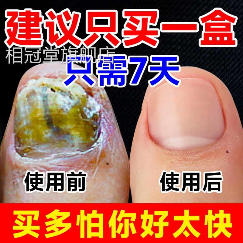 阿莫罗灰指甲芬搽剂复液脱甲修膏去除增厚药水正品官方旗舰店相冠