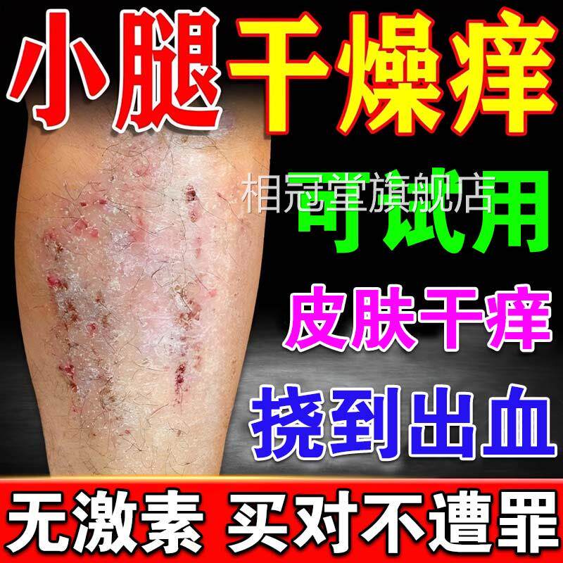 冬天腿痒小腿皮肤干燥止瘙痒抑菌效药老年人身上掉皮屑红疙瘩特膏