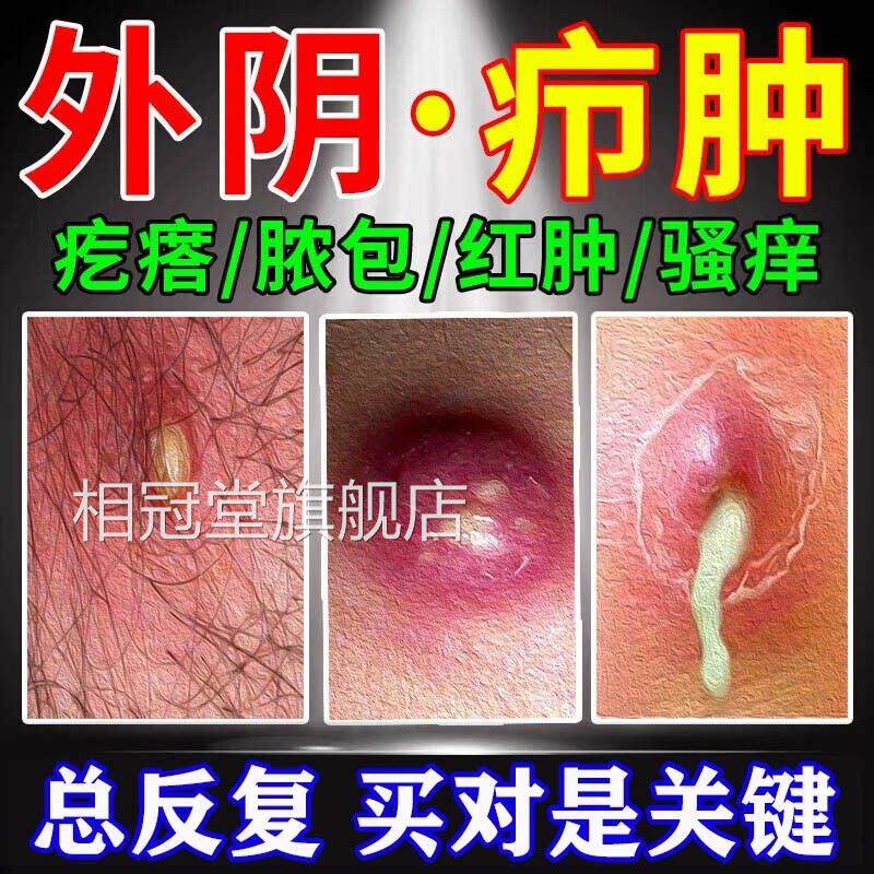 外阴疖拔毒膏火疖子药膏拔脓膏脓肿包硬块敷贴屁股上私处长有痘痘