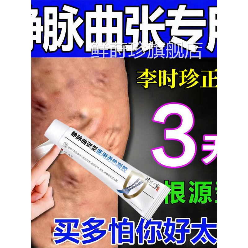 静脉曲张药膏静脉曲张专用效药膏药蚯蚓腿治疗血贴管堵塞疏通凝胶
