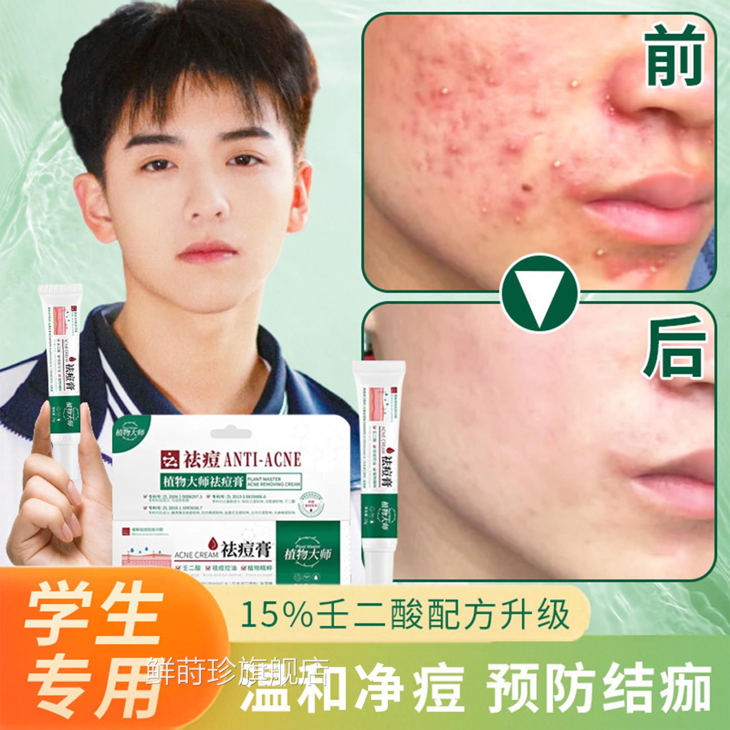青少生年痘膏痘去祛正品青春痘初中女额头痤疮治脸上痘痘的药膏鲜