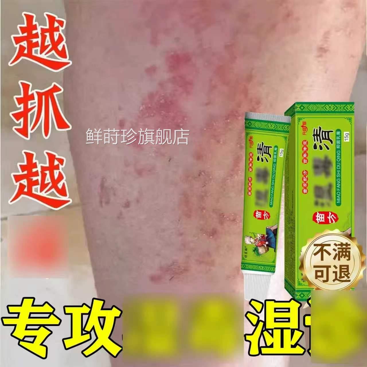 肚子肚皮周围红斑专用除湿痒膏皮肤止止痒去外用顽固皮炎根鲜莳珍
