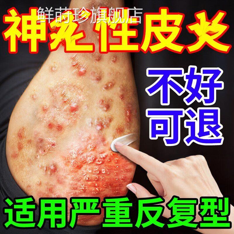 皮肤鲜痒日本口疗神经性皮顽固反复湿瘙外用膏药病皮疹克进星治鲜