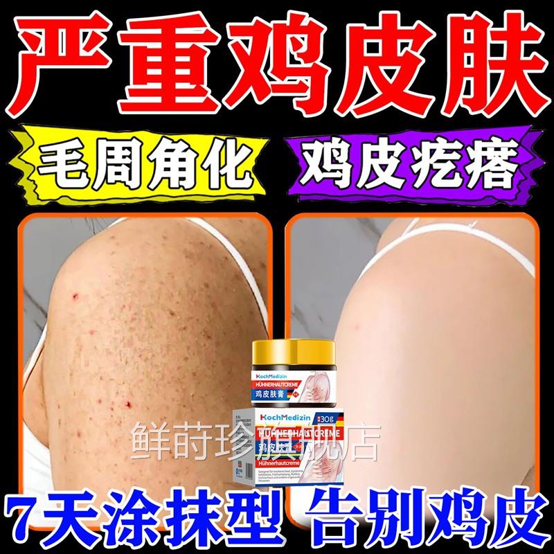 去鸡皮肤疙瘩药毛囊角化质症角专去除膏全身手臂腿鱼鳞用神器儿童