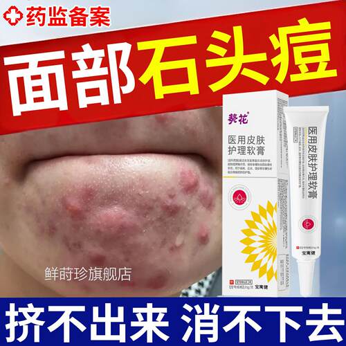 祛腺石头痘下巴反复长痘痤疮皮脂结节硬块痘痘去红肿囊肿脓包药膏