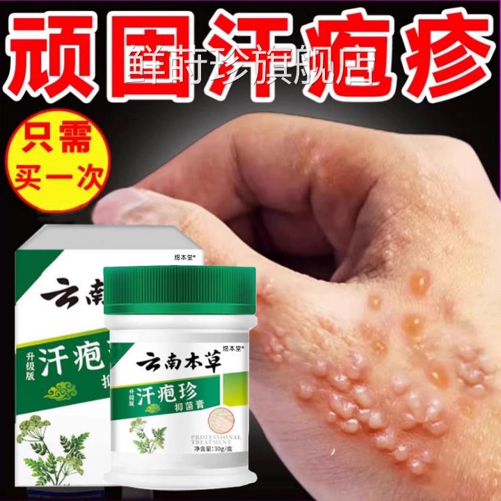 手上起小水抑菌汗泡疱止痒中药鹅掌风真菌泡感染手气湿痒疹专膏鲜