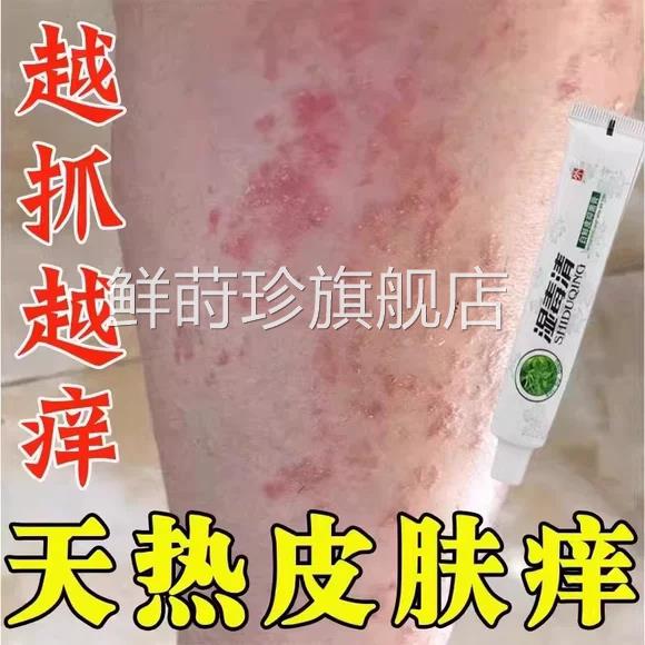 夏天小腿热痒湿成人止膏出汗身上痒天热皮肤疹瘙痒热疙瘩红疹毒痒