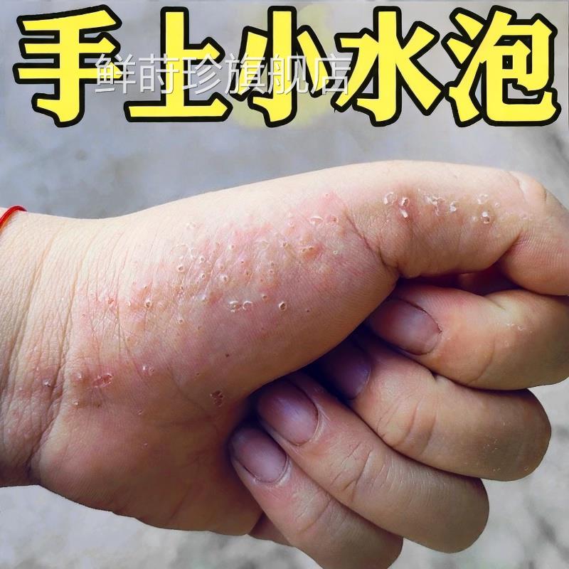 手上起小水泡汗疱汗疹湿痒红疹脱皮去状疱疹外用顽固皮炎软药膏根