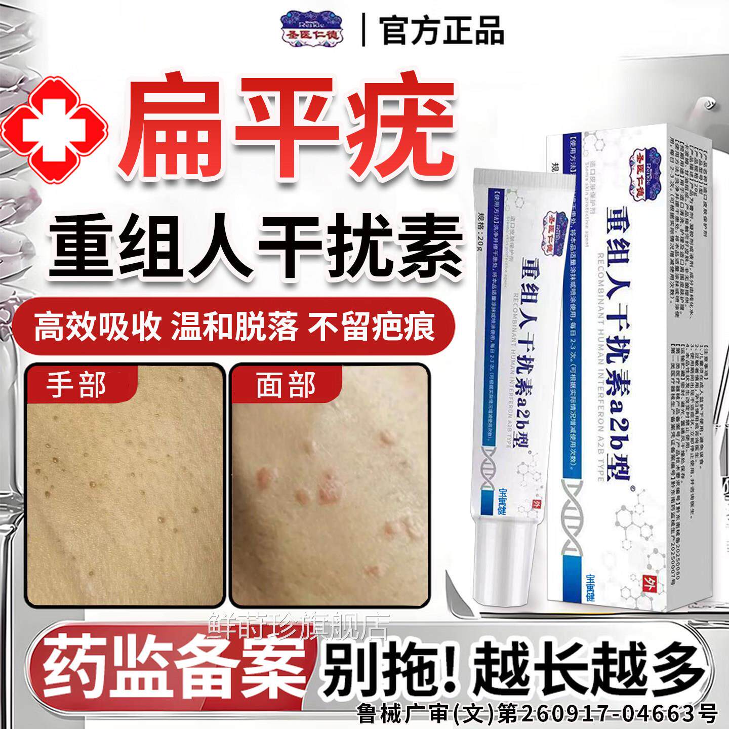 重组人灵干扰素a2b扁平疣专用去除软膏一抹去b2根凝胶官方旗舰店