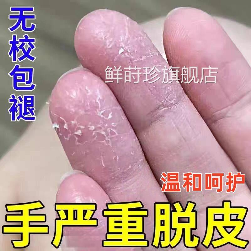 手足脱皮手严重脱皮专用蜕皮干燥膏起皮感染季节性儿童手脱皮正品