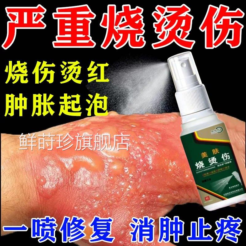 美肤烧烫伤喷雾烧伤水泡瘙痒红肿痛湿润降温修复皮肤伤口消炎止剂