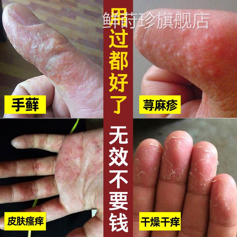快速止痒皮肤瘙痒外用干痒止痒喷剂全身脚瘙痒气止痒脱皮杀菌喷剂