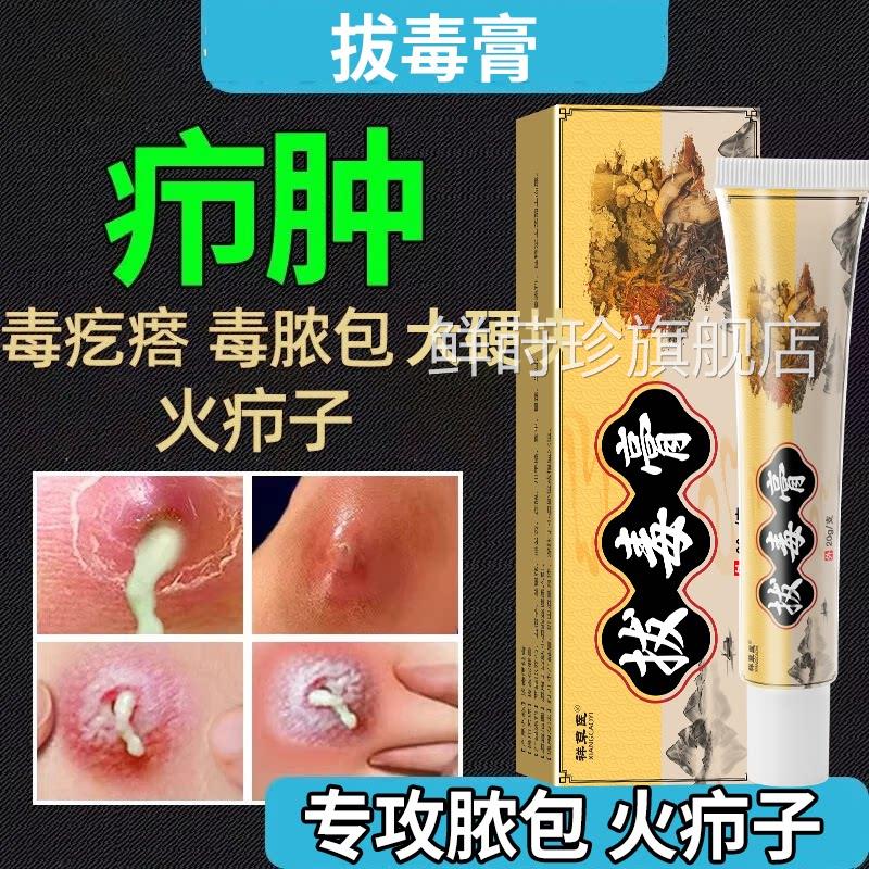 屁股坐板股疮屁股痒膏红肿火疖子屁长痘痘起热疙瘩痒久坐拔毒膏鲜