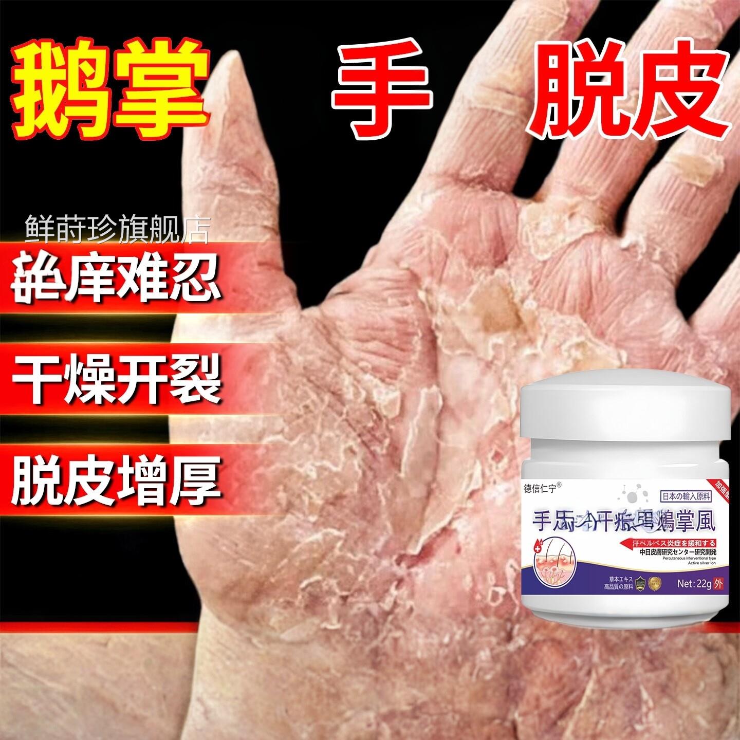 鹅掌用风手膏脱皮干裂真菌感角染化型湿去手部角化皲裂膏鲜莳珍旗
