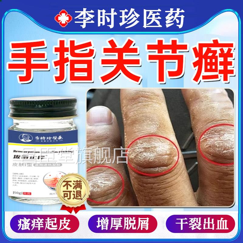 手指关癣手癣膏脱皮节干 干裂真菌感染毒癣康湿疹疱疹止痒药膏正