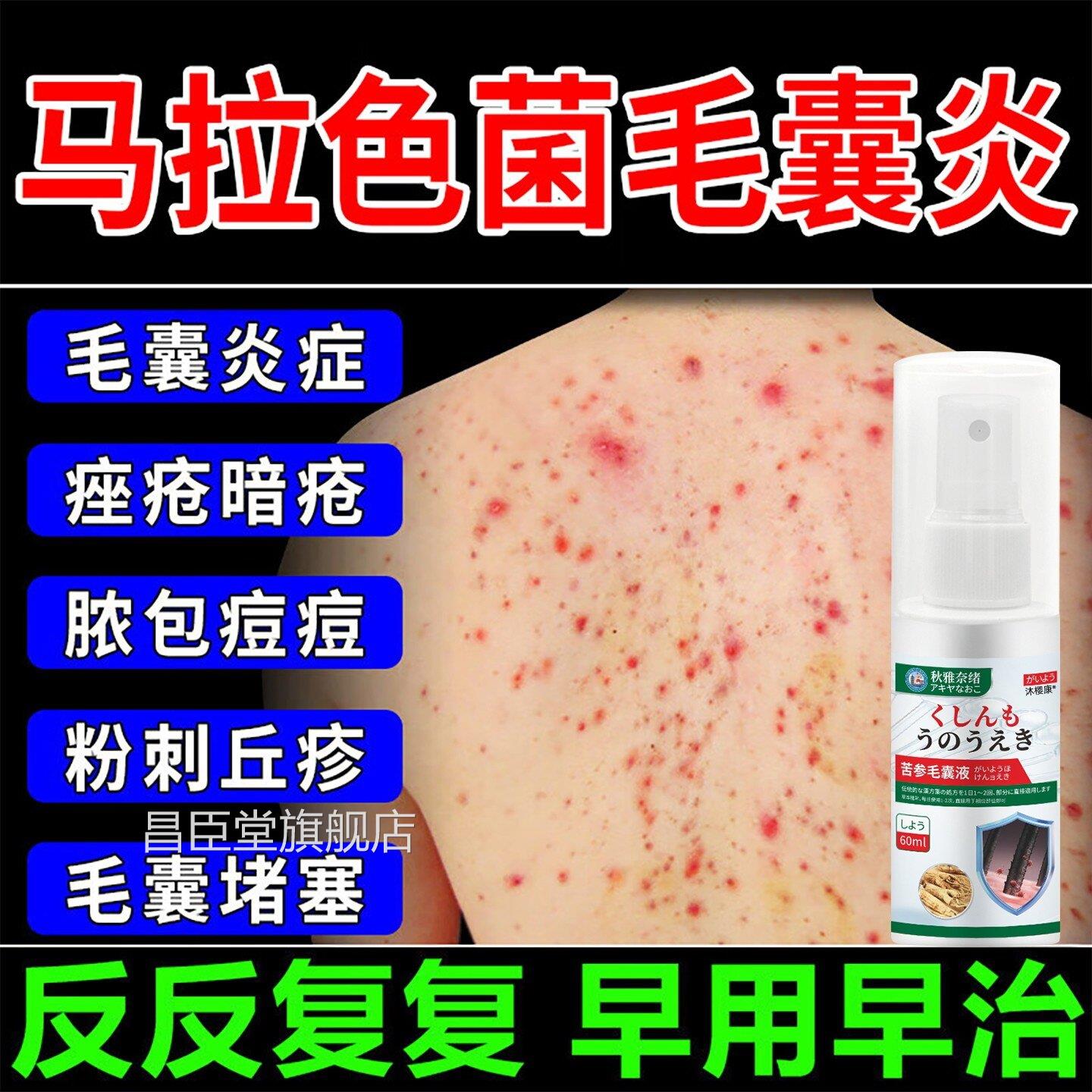 毛囊炎喷剂前胸后背马拉色菌毛囊炎瘙痒红肿痤疮瘩疙真菌感染痘痘