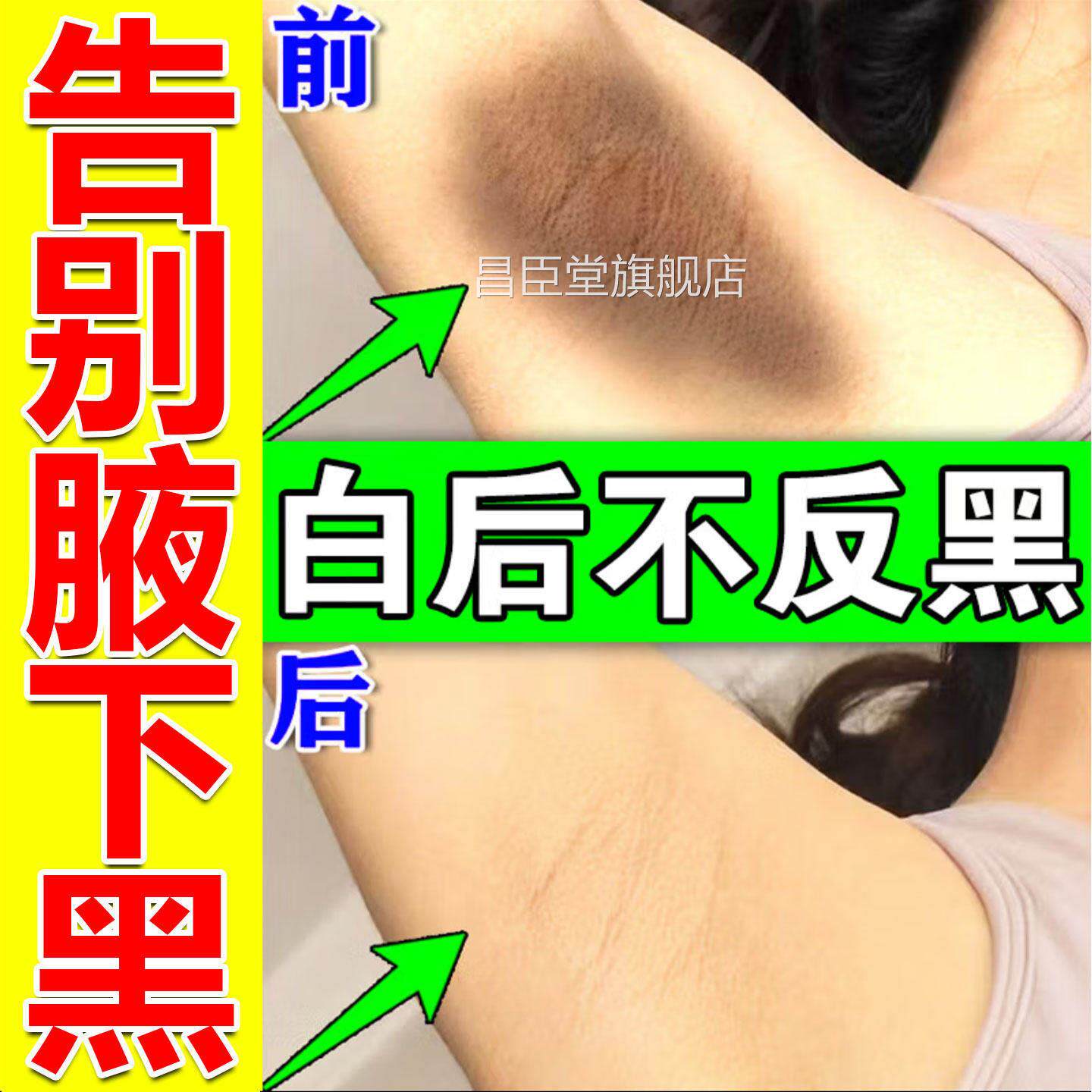 腋下去i黑美i白腋窝黑色素沉淀神器脖子棘皮胳膊肘除去除死皮药膏