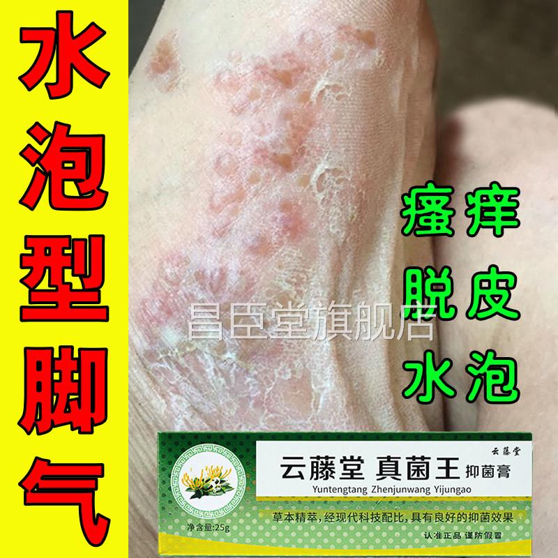 效真菌王脚气膏真菌感染止痒脱皮杀菌烂脚丫糜烂小强水泡官方正品