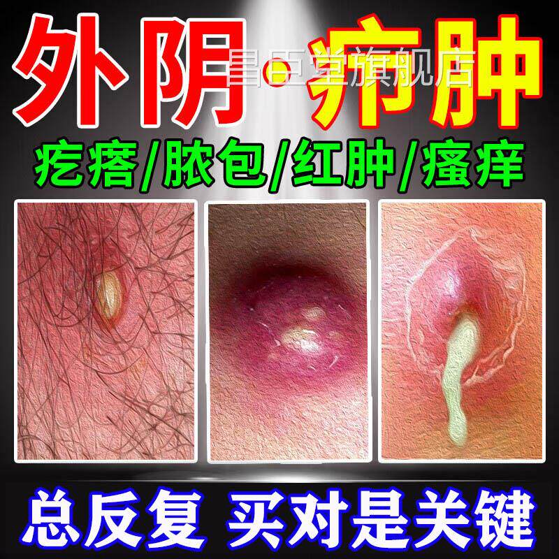 外阴疖肿拔毒膏火疖子药膏拔脓脓包膏硬块敷贴屁股上私处长痘痘LL
