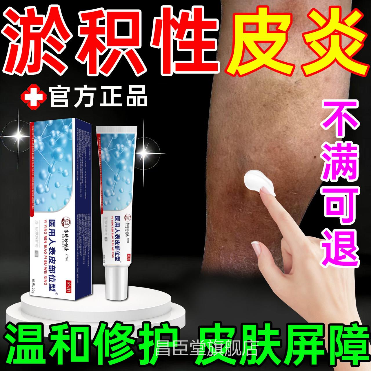 淤炎积性皮炎小腿发黑发紫瘙痒红肿静脉曲张静脉湿疹专用修复膏PP