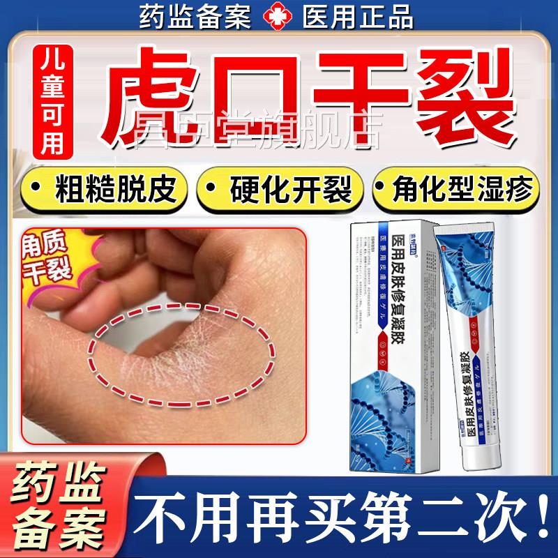 虎口手部角化型湿疹开裂手干裂脱皮真菌感染干性皲裂性手膏癣药TK