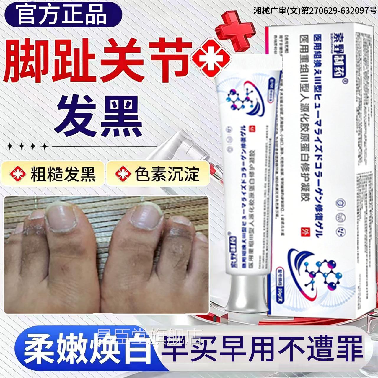 脚趾关发黑关节癣出现黑色干肉去死皮节黑色素沉淀湿疹干燥厚茧BD