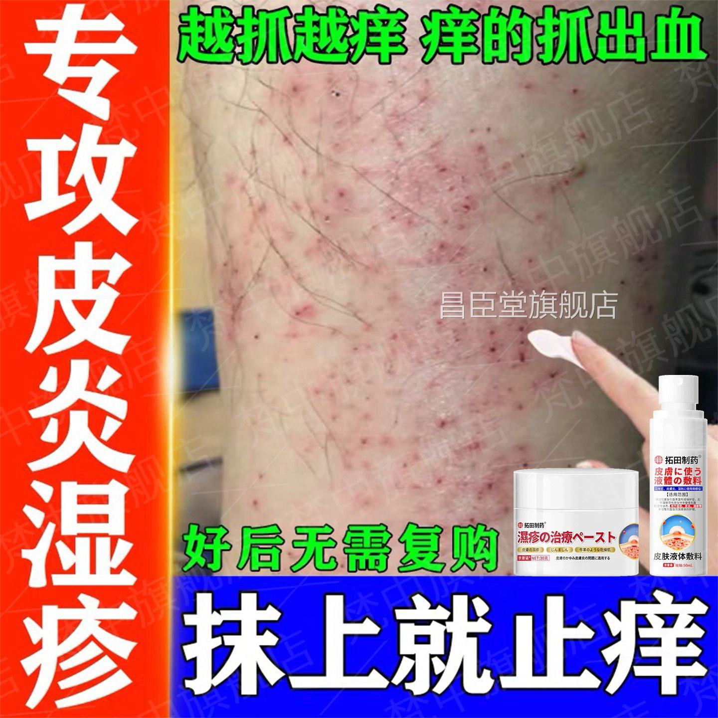日本皮肤湿疹止痒喷剂皮炎护理液体敷料全身干燥瘙痒用医止痒药膏