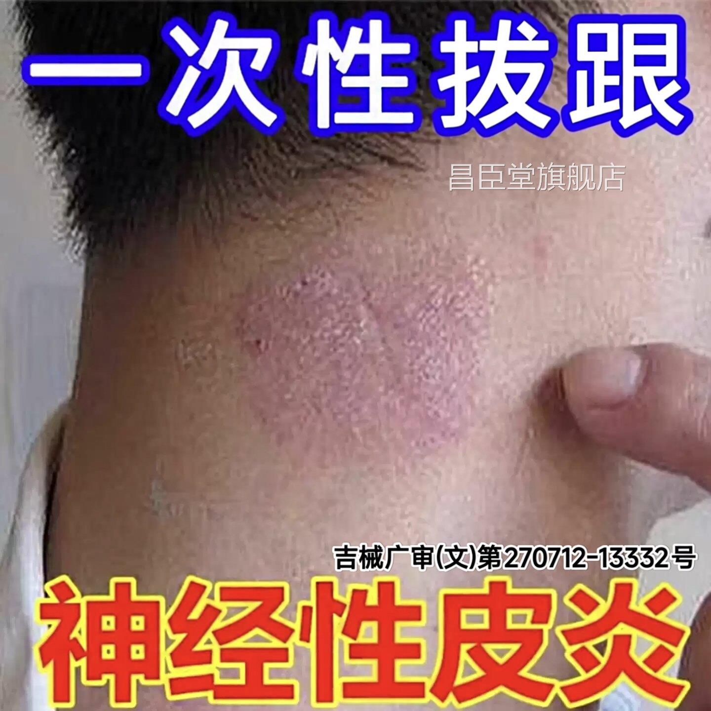 日神本经性皮炎祛除皮肤瘙痒真菌感染顽固止痒杀菌无激素外用药膏