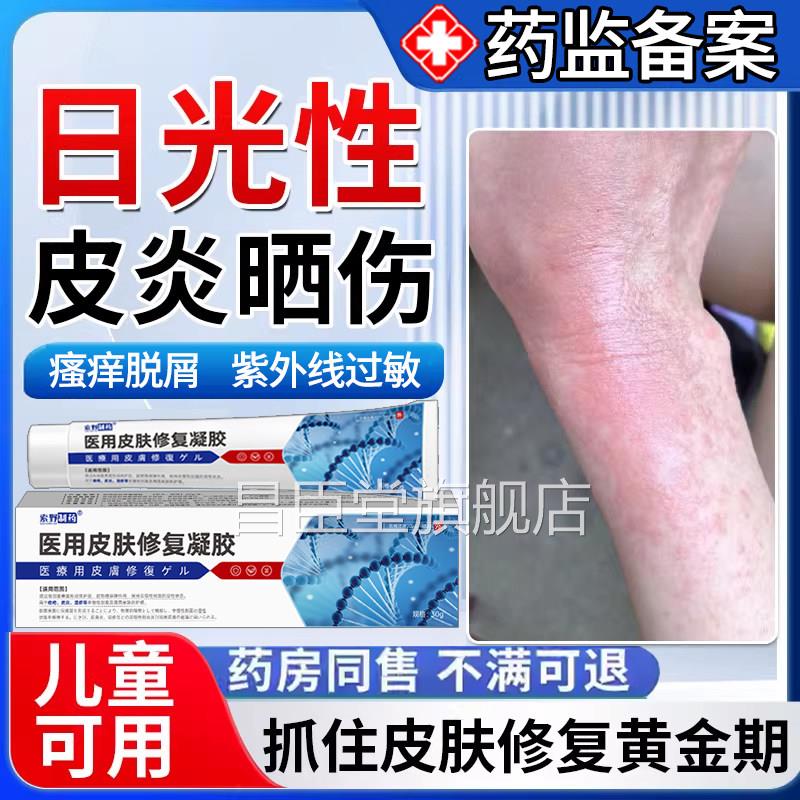 日光性皮晒炎紫外线过敏瘙发痒太阳伤皮肤修复霜专用药房同款膏Y7