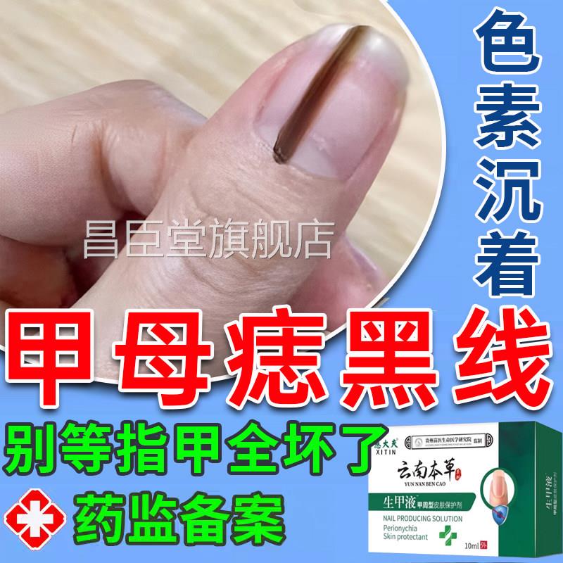 甲母痣黑线莫指甲长黑色竖纹药膏阿药水黑灰指甲罗芬开裂搽剂UU昌