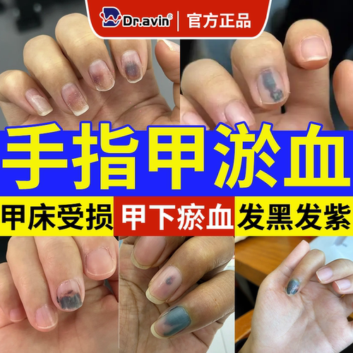【手指甲淤血】dr.avin旗舰店