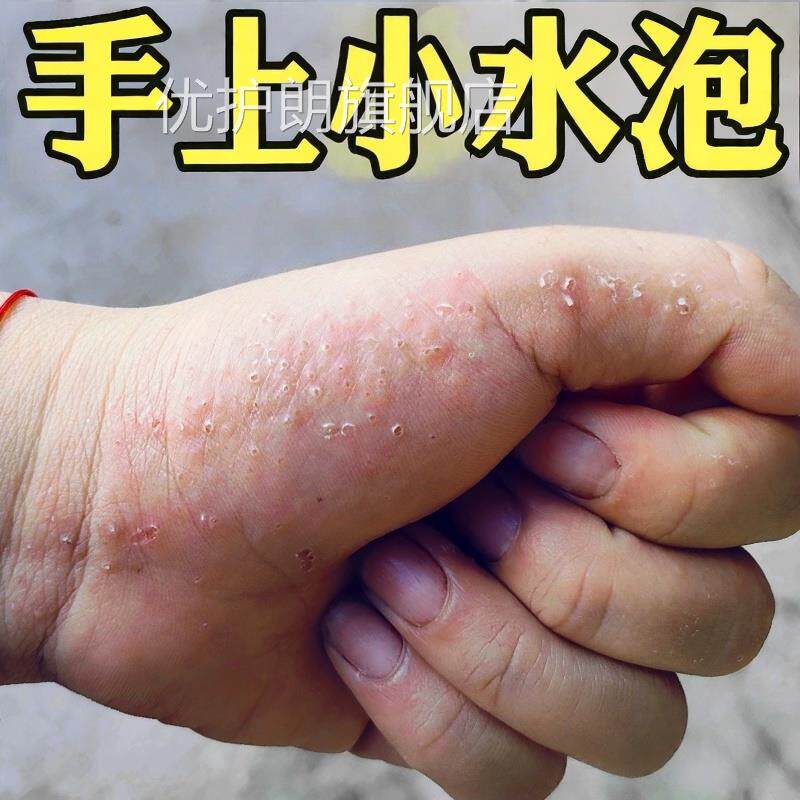 手上起小水软泡汗疱疹湿痒红疹脱皮去汗状疱疹外用顽固皮炎药膏根