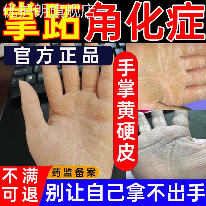 掌跖角化症掌趾脓包膏手心发黄增厚硬皮角化型湿疹脱皮干裂喷剂PP