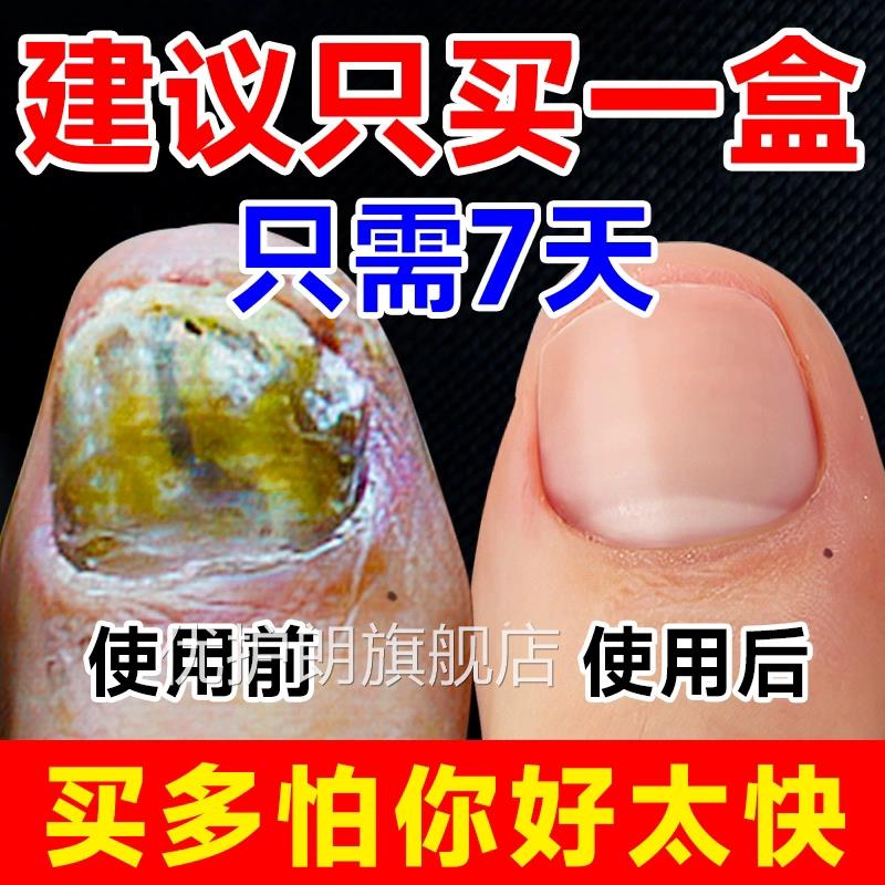 阿莫罗灰指甲芬搽剂修复液甲膏去除增厚脱药水正品官方旗舰店优护
