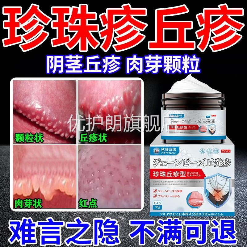 珍珠丘疹膏龟头炎包皮炎阴茎冠状沟珍珠粒疹去除小疙瘩真菌感染膏