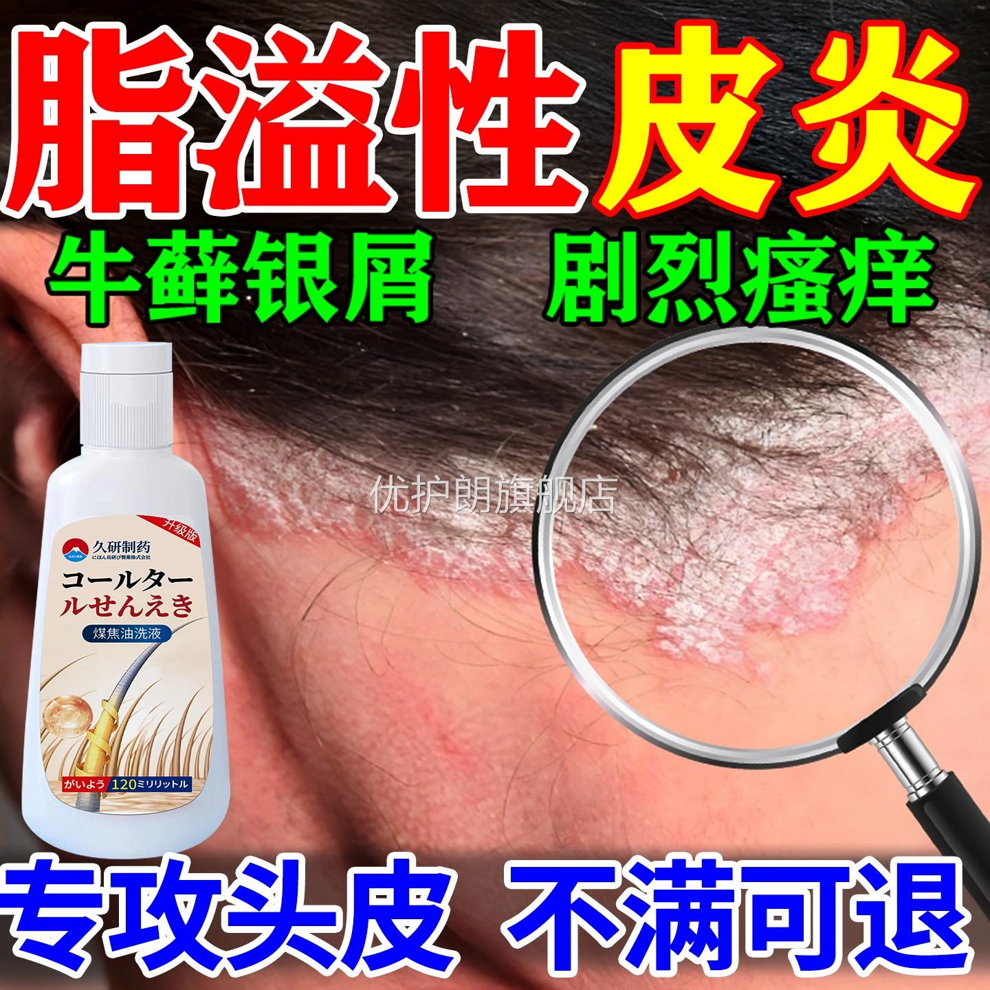 煤焦油洗剂脂溢性皮炎去屑止痒除螨洗发水真菌感染神器头癣止痒膏