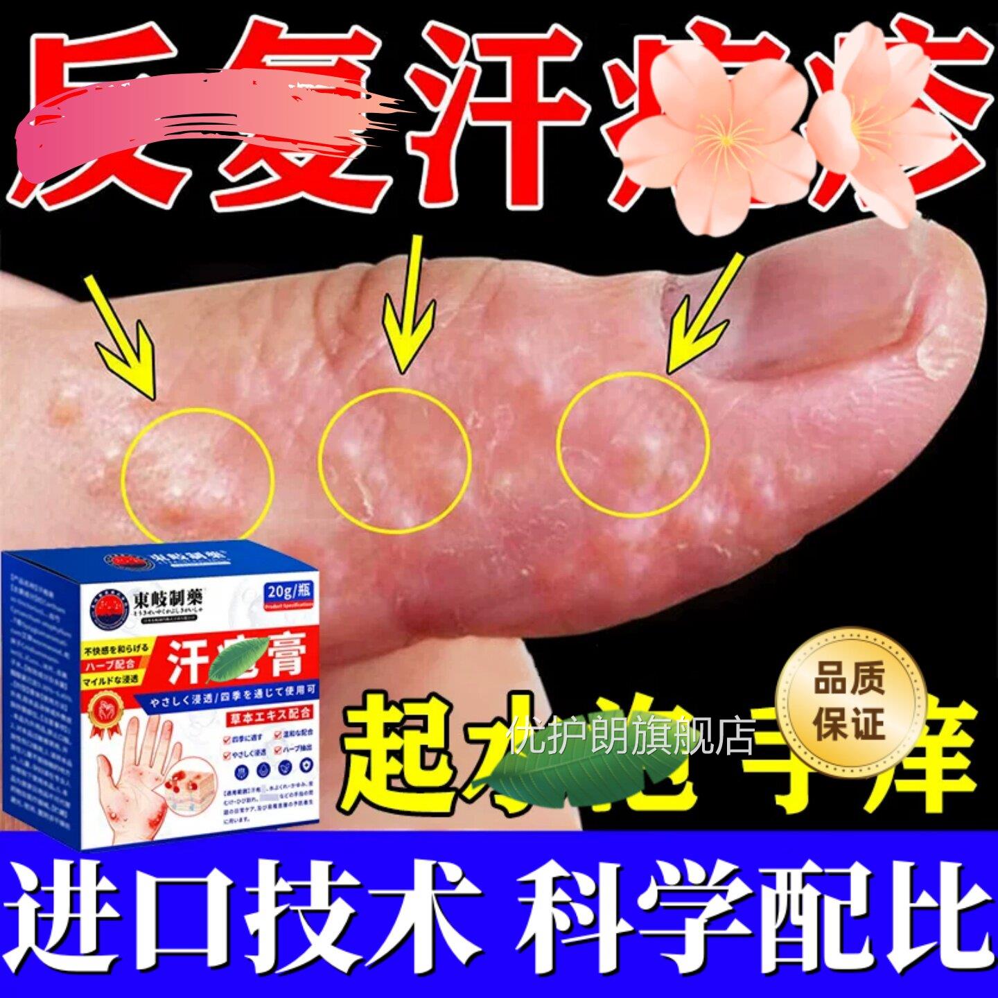 手起小水泡汗状疱痒疹带状真杀菌感染止湿手气脱皮痒专去上疹用膏