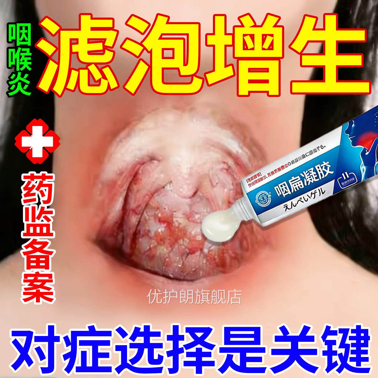 治疗咽炎喉炎慢性咽根专除用异物感咳嗽嗓子有痰喉咙滤泡增生淋巴