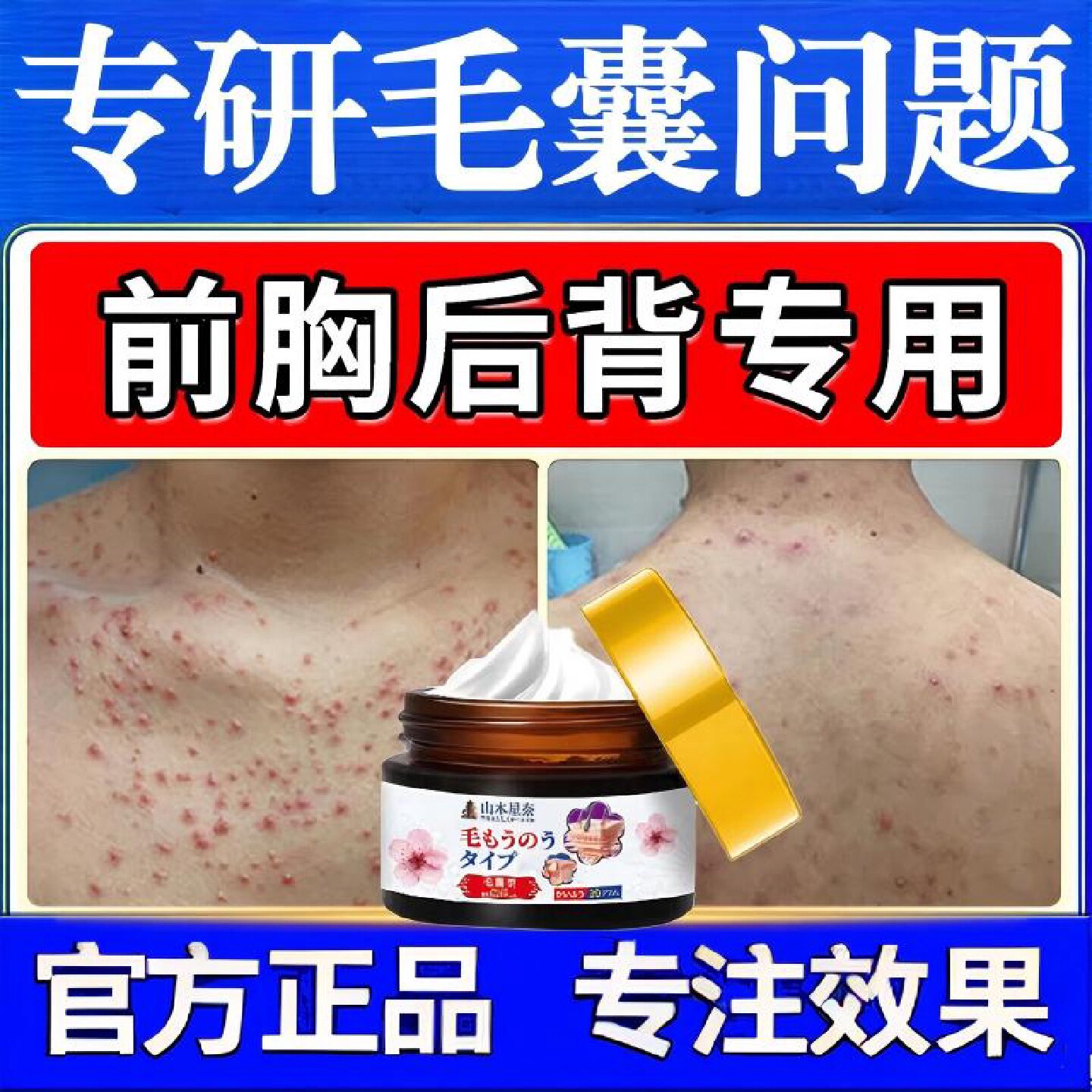 日本毛囊痘痘消除膏前胸后背背粒消除螨祛硬痘去除马拉色菌旗舰店