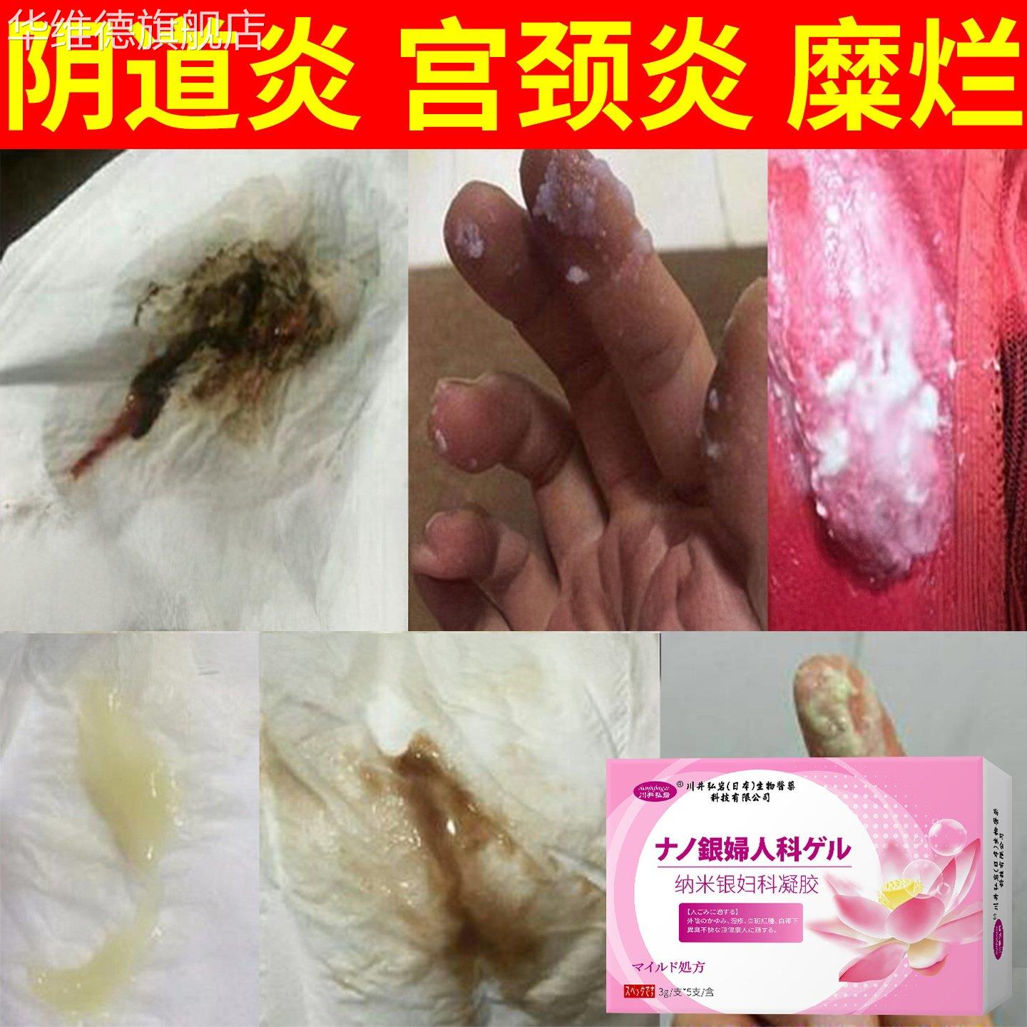 妇科凝胶宫颈糜烂保养私处收紧霉菌性豆腐渣阴道护理炎女抑菌正品