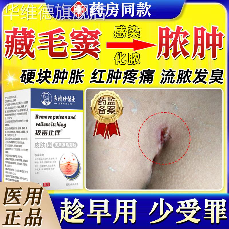 藏毛窦药膏感染化脓脓肿囊肿骶骨尾肛门硬疙瘩坐疮毛囊炎拔毒拔GX
