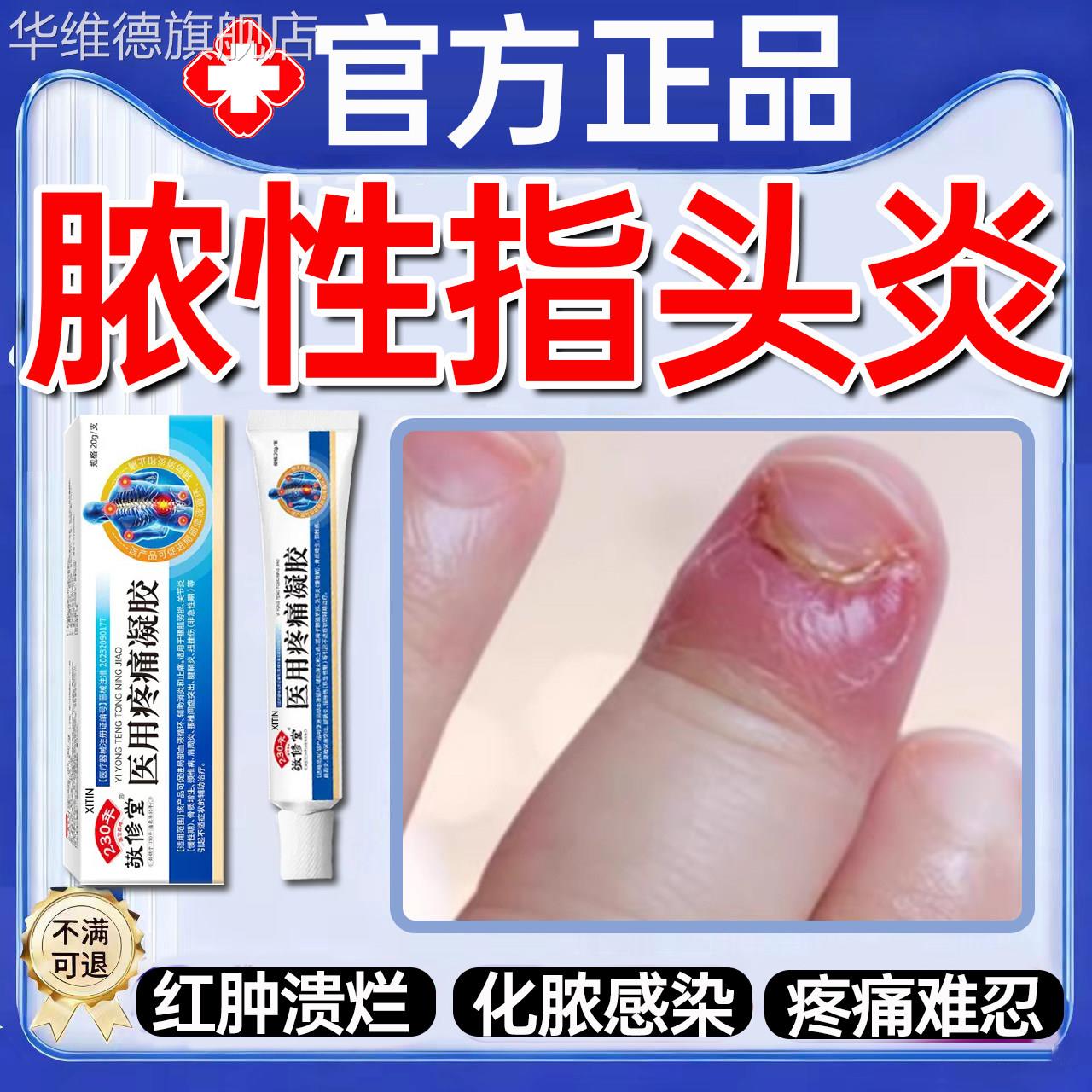脓性指头炎手指真菌感染甲内红肿疼溃烂甲沟炎边缘流脓消肿化脓UU