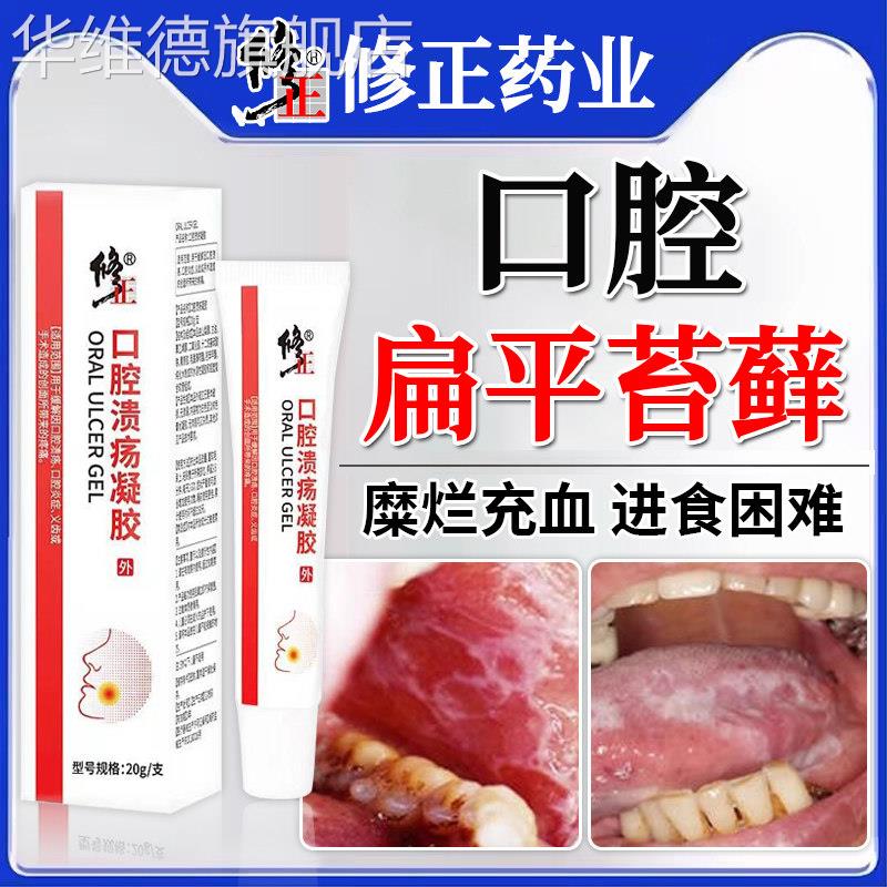 口腔扁平苔藓专用治疗黏膜修复白斑液膏纤维化口疮溃疡充血GX华维