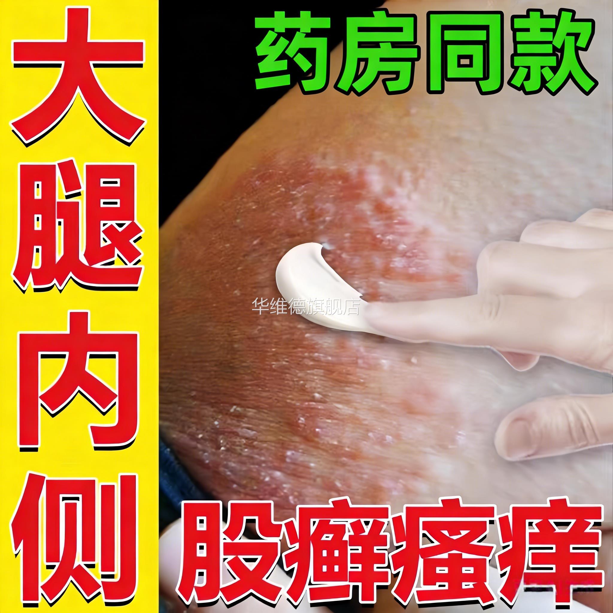 湿毒清牛皮癣股藓大腿内侧根皮肤瘙痒真菌感染湿疹止痒软膏银屑病