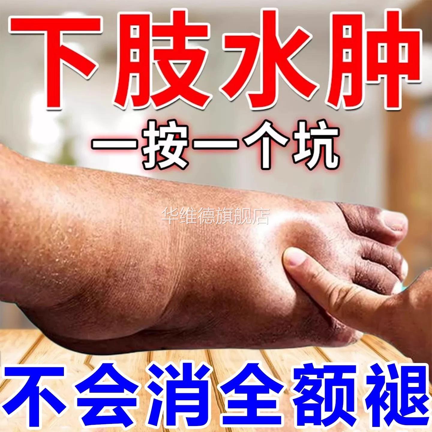 脚肿肿消的药利尿排水肿神器去老人小腿部下肢浮肿特专效用华维德