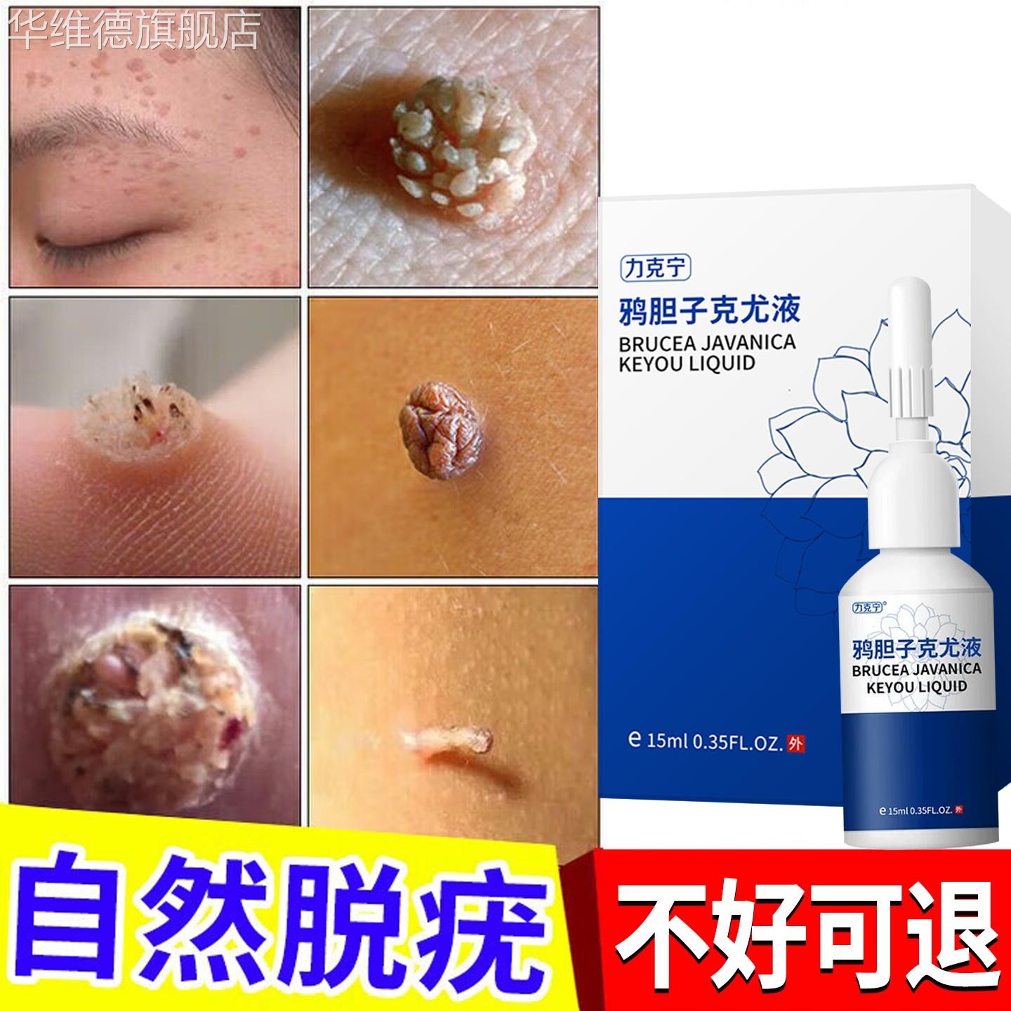 脖子上小肉球肉粒肉刺疙瘩赘肉丝状疣瘊子去除神器腋下疣一抹无忧