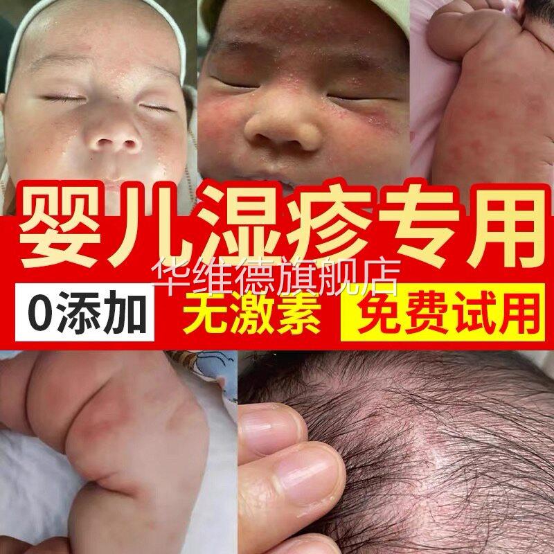 宝宝湿疹膏婴儿专用无激素止痒去恨外用顽固皮炎瘙痒抗菌消炎润肤