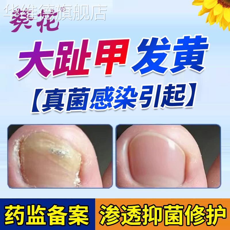 葵花脚指甲发黄变厚专用增厚变硬趾甲治疗脱甲灰指甲癣膏真菌感染