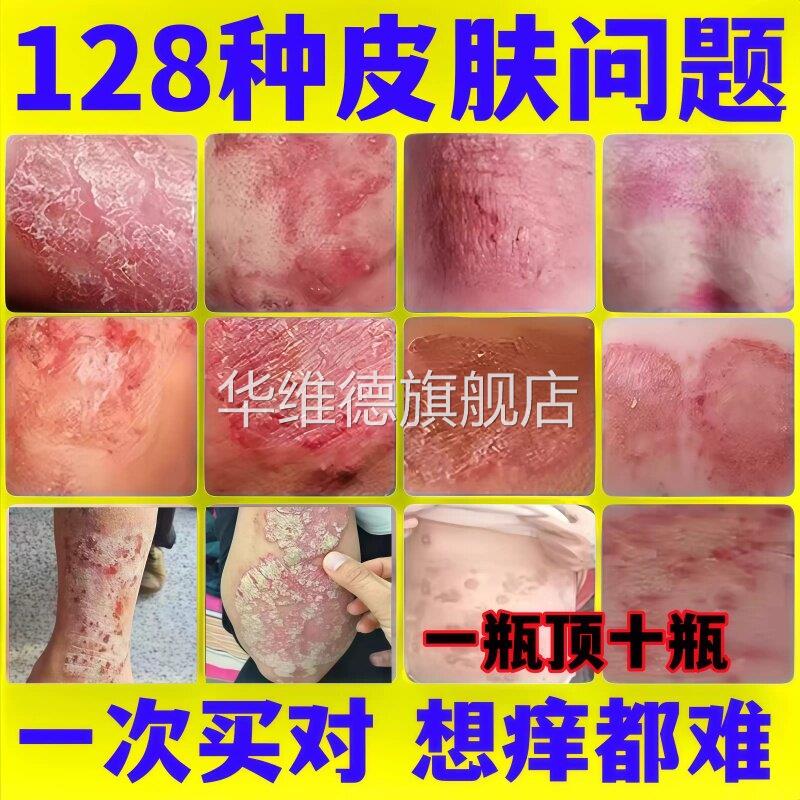 股藓大腿内侧根皮肤瘙痒真菌感染牛皮藓药体股癣去湿屁股止痒膏疹