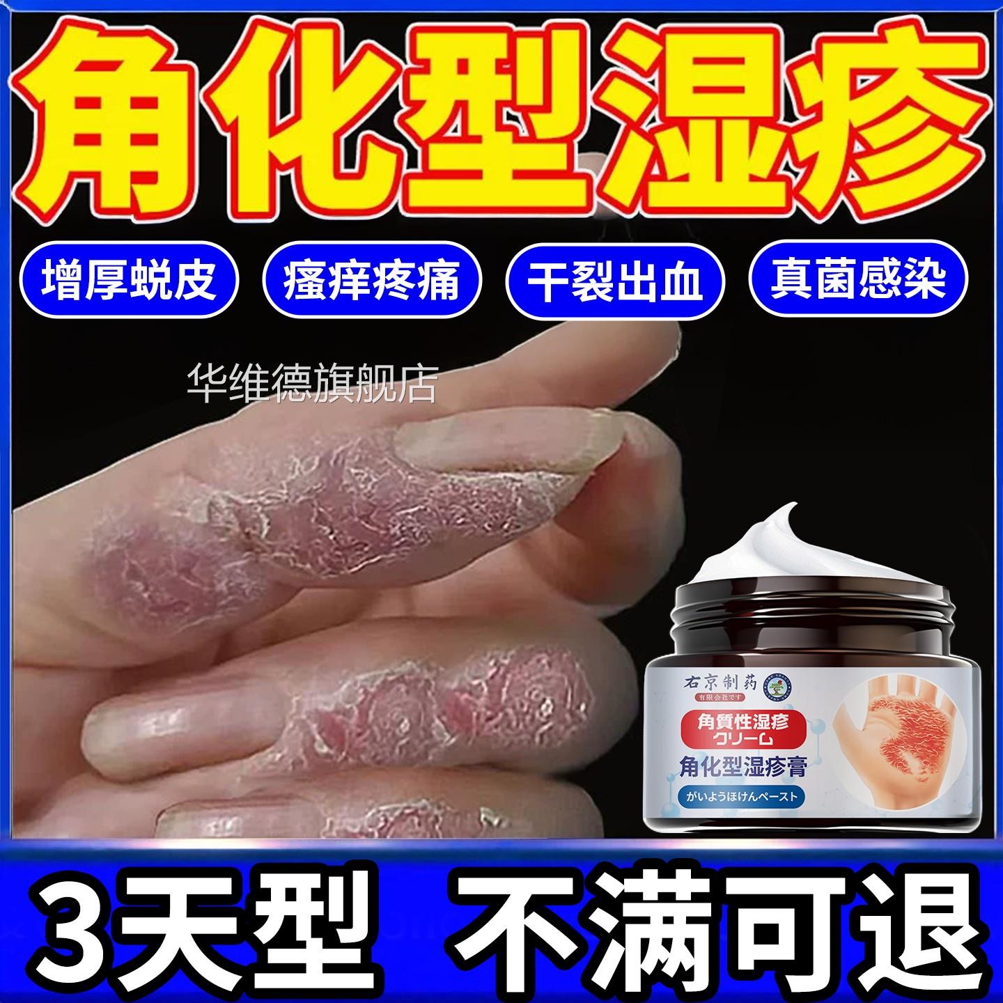 角化型湿疹部脱皮干裂真菌感染止痒手专用手足癣去手脚根部止痒膏